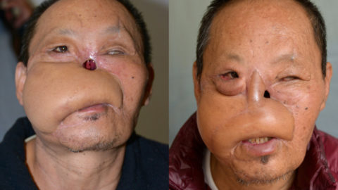 Interplast Bhutan Nose Reconstruction