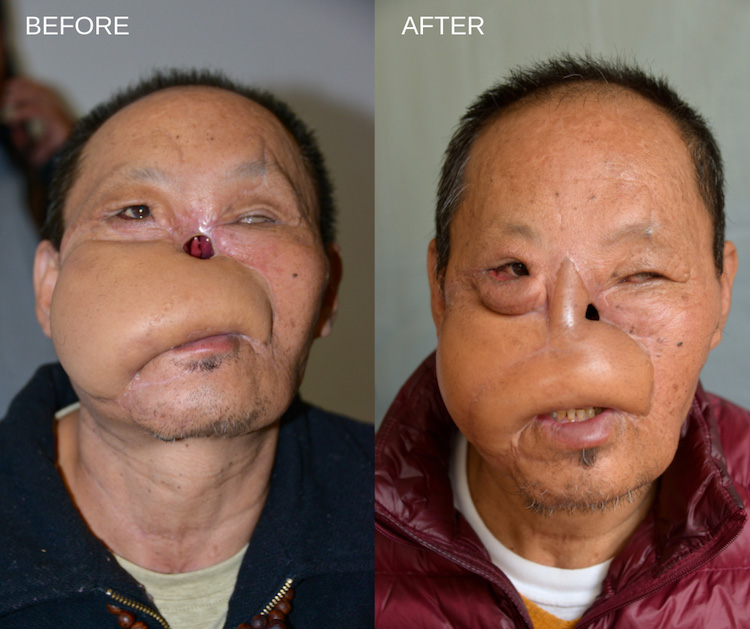 Interplast Bhutan Nose Reconstruction