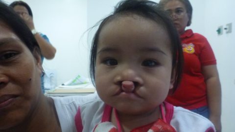 Before cleft palate repair