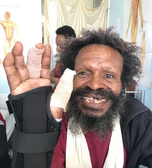 A man smiling holding up his hand which is bandaged