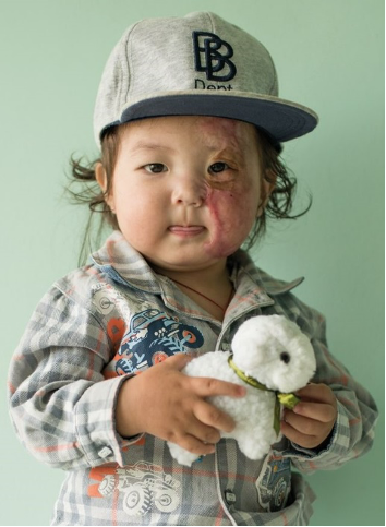 Ankhbayar, a young boy with a burn scar over his left eye, holds a soft toy lamb.