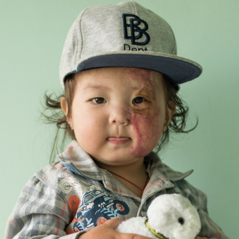 Ankhbayar, a young boy with a burn scar over his left eye, holds a soft toy lamb.