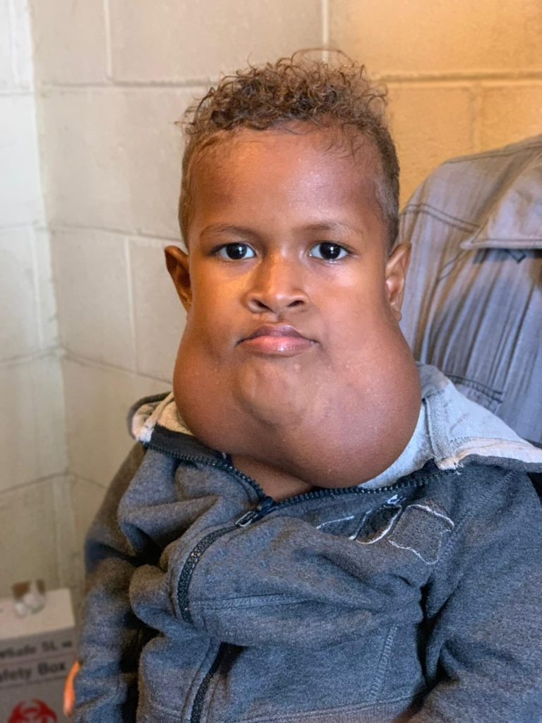 Frezole, a young boy with a large growth under his jaw looks at the camera.