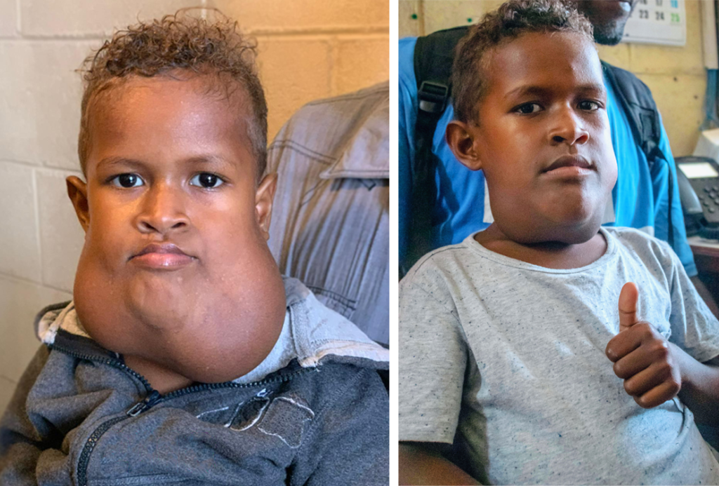 Two pictures of Frezole, a young boy. In the first, he is two years old and has a large mass in his jaw. The second he is four and his mass is significantly reduced, but still present. He gives a thumbs up to the camera.