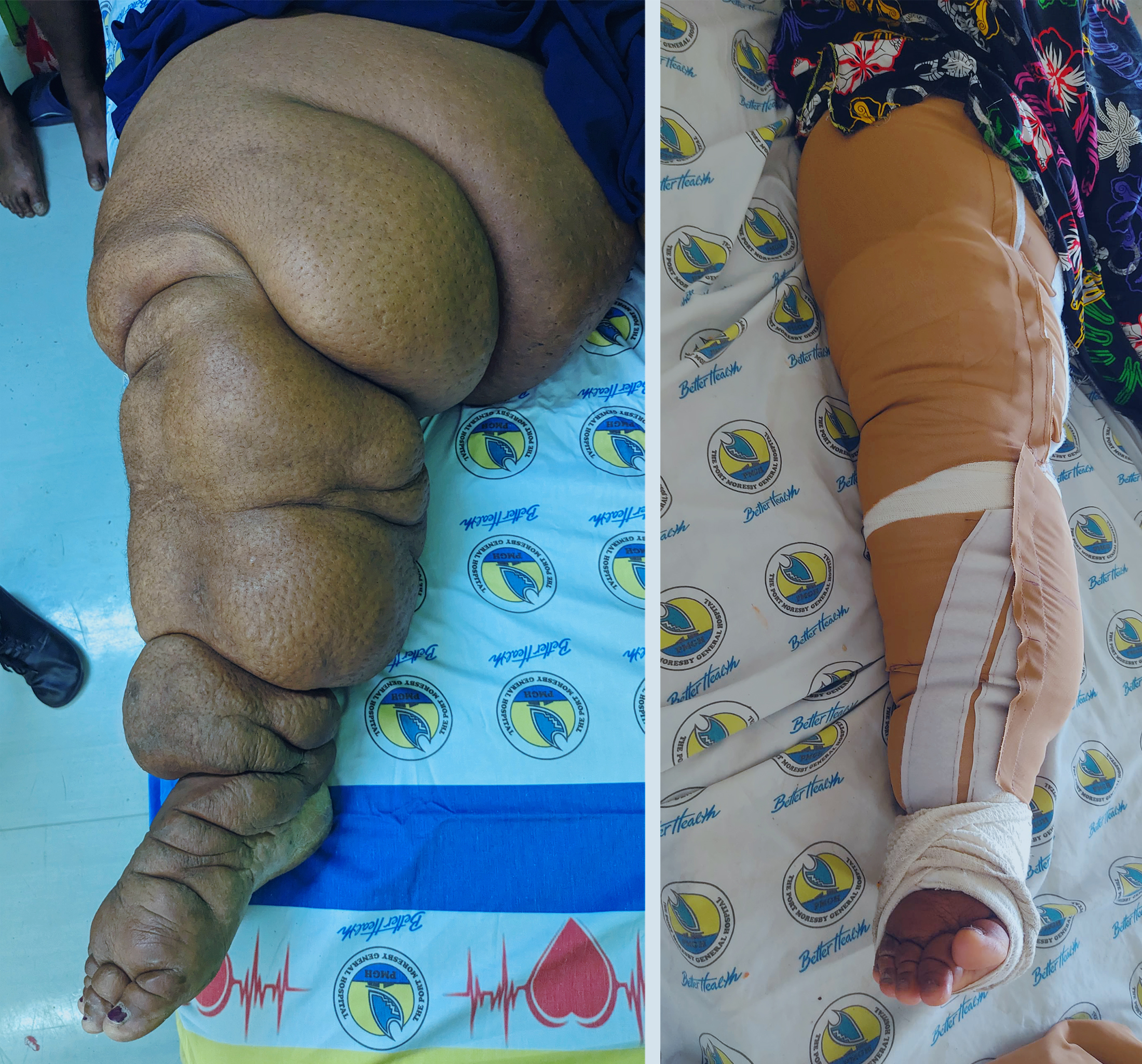 Two photos. Left: Christina’s large, swollen leg. Right: Christina’s leg reduced in size, dressed in her compression garment.