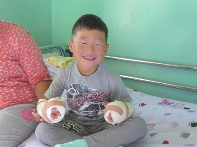 A young boy with hands bandaged sits on his hospital bed smiling.