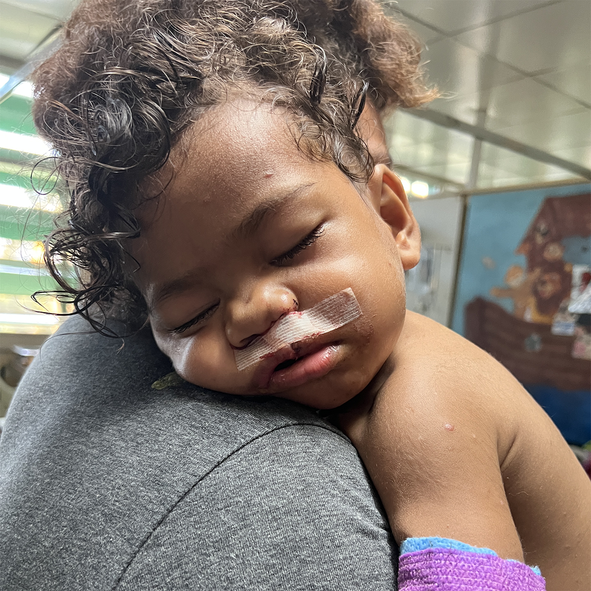 A baby with a bandage on their top lip sleeps in their mother's arms.