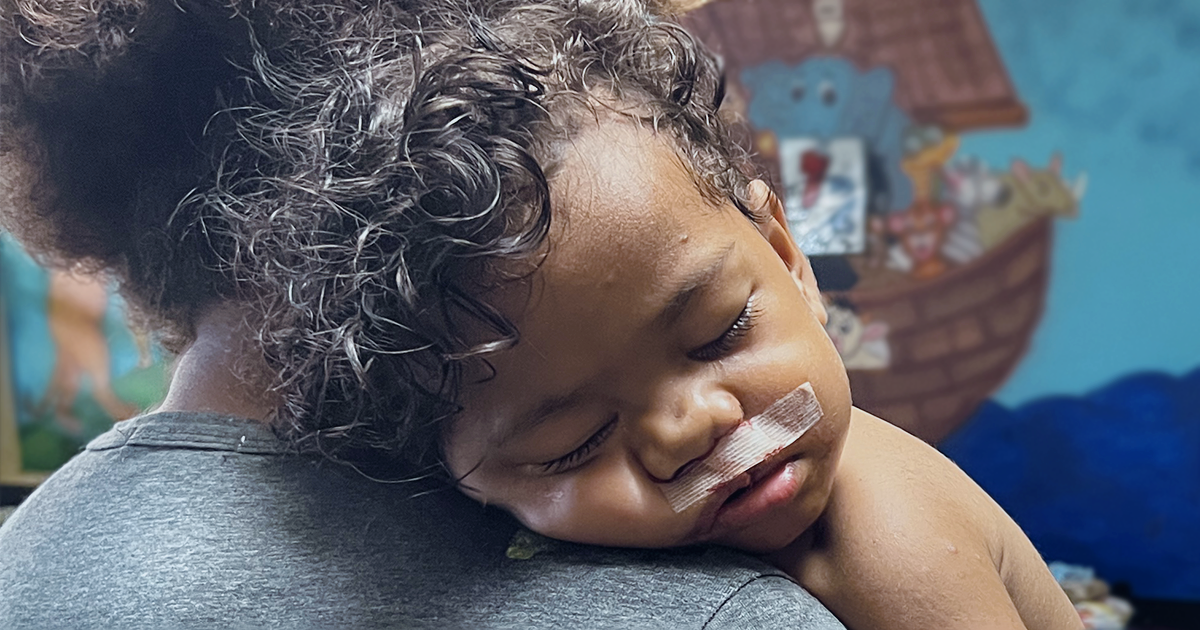 A young with a bandage on his upper lip child sleeps peacefully in his mothers arms.
