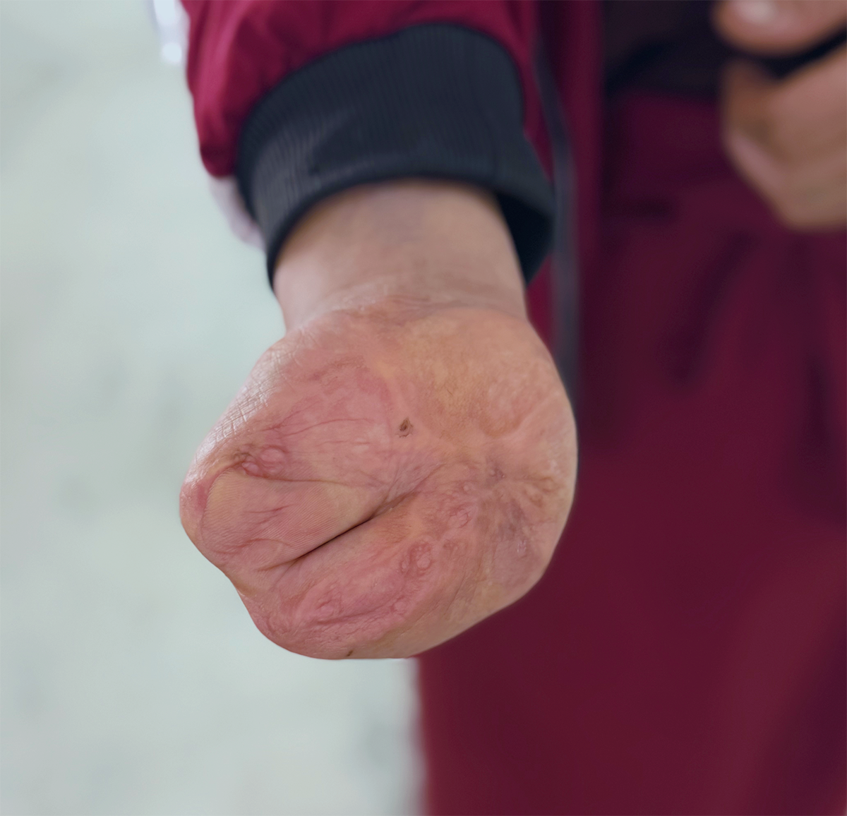 Close up of hand with almost no definition between fingers.